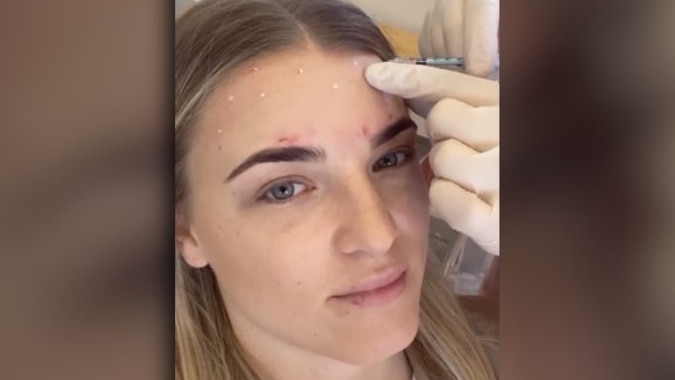 ‘Baby botox’ is on the rise among teens and people in their 20s, but does it prevent wrinkles?