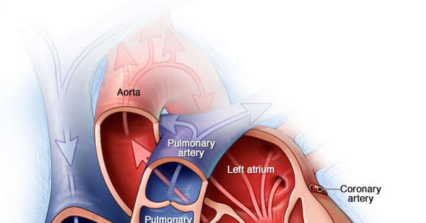 Aortic valve repair and aortic valve replacement