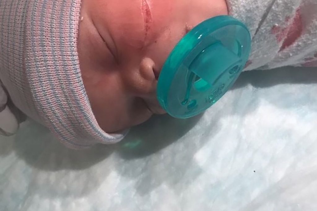 Recém-nascido leva 13 pontos no rosto após ser cortado acidentalmente em cesariana de emergência – Pais